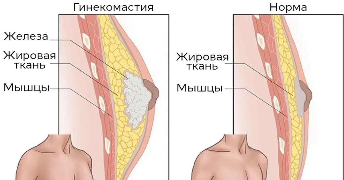 Гинекомастия. Как её лечить и с чем оно связано?